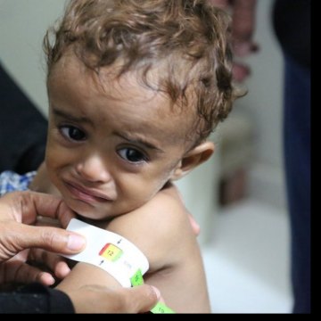 الیونیسف: سوء التغذیة بین الأطفال فی الیمن یصل إلى أعلى مستویاته