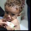  آلاف-الیمنیین-عالقون-جراء-المراقبة-المشددة-المفروضة-من-التحالف-على-العاصمة-صنعاء - الیونیسف: سوء التغذیة بین الأطفال فی الیمن یصل إلى أعلى مستویاته