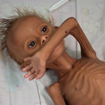 تاکنون بیش از 10 هزار کودک یمنی بر اثر فروپاشی نظام بهداشتی کشته شدند