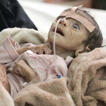 85 هزار کودک یمنی قربانی سوء تغذیه