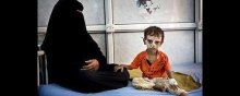  Malnutrition - The Photos the U.S. and Saudi Arabia Don’t Want You to See
